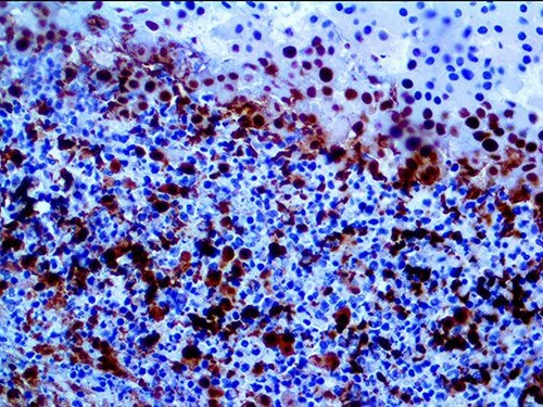 IHC of SMAD4 / DPC4 on an FFPE Pancreatic Cancer Tissue